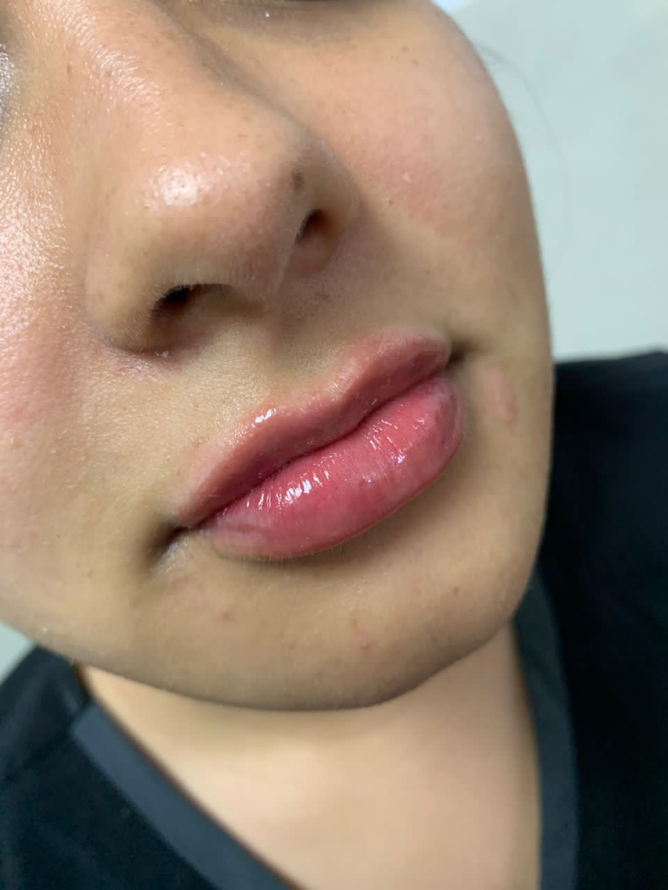 Resultado ácido hialurónico · definición de labios